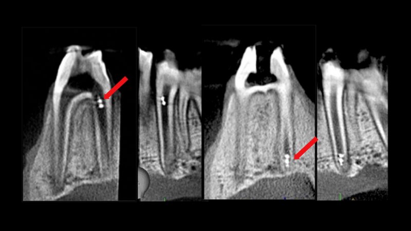 Vďaka novej technológii by sa nám zuby v budúcnosti mohli starať nanoroboti